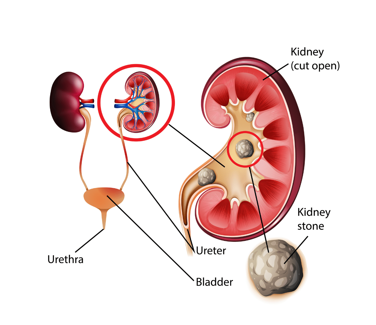 Medical illustration showing a kidney with stones, highlighting their location and impact on the ureter, bladder, and urethra.