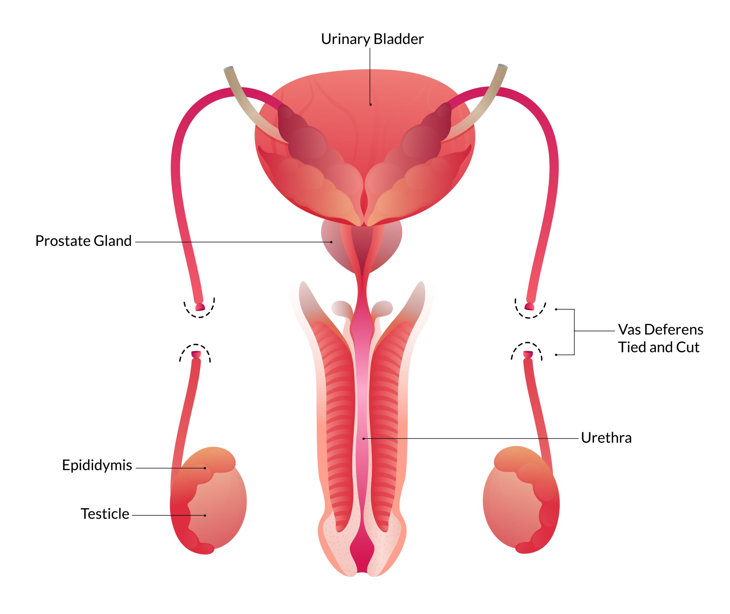 Diagram showing the male reproductive system, highlighting the vas deferens tied and cut during a vasectomy procedure.